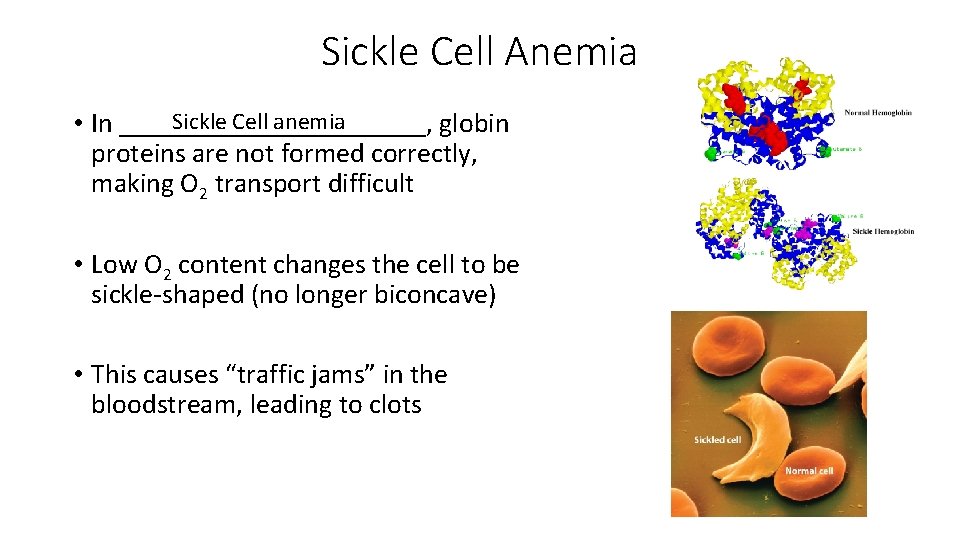 Sickle Cell Anemia Sickle Cell anemia • In ___________, globin proteins are not formed