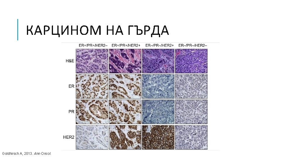 КАРЦИНОМ НА ГЪРДА Goldhirsch A, 2013. Ann Oncol. 