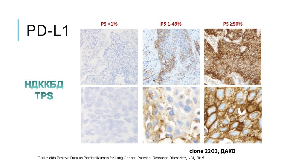 PD-L 1 clone 22 C 3, ДАКО Trial Yields Positive Data on Pembrolizumab for