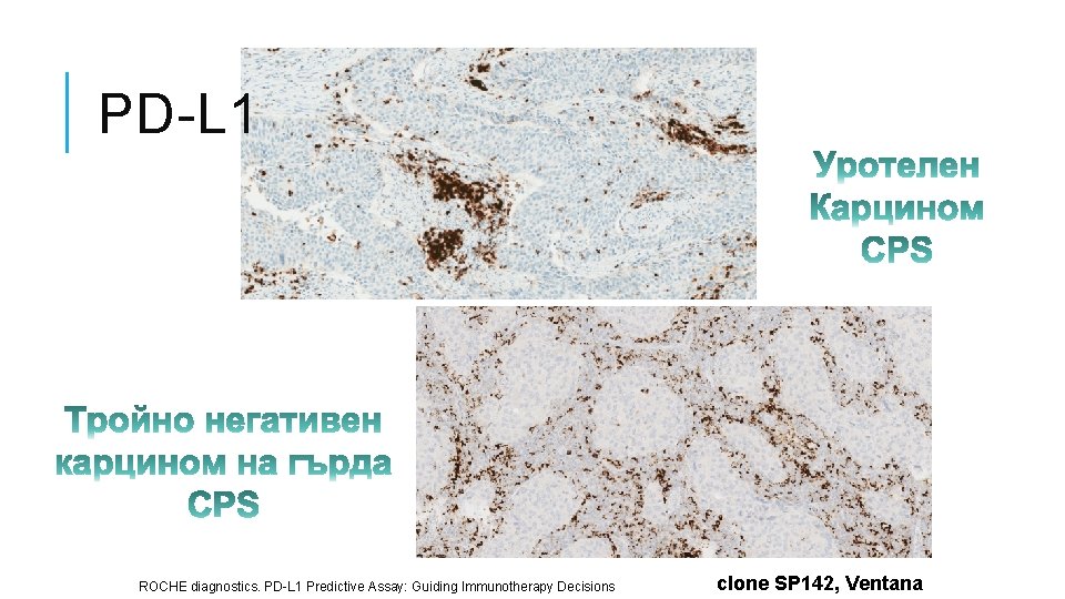 PD-L 1 ROCHE diagnostics. PD-L 1 Predictive Assay: Guiding Immunotherapy Decisions clone SP 142,
