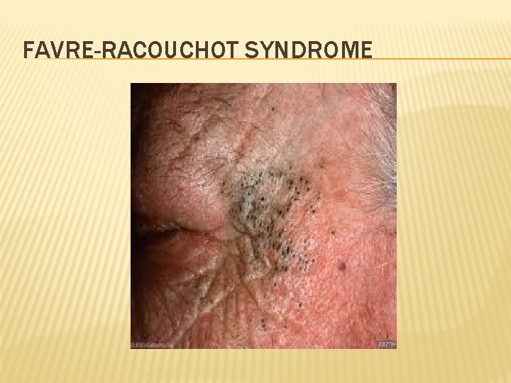 FAVRE-RACOUCHOT SYNDROME 