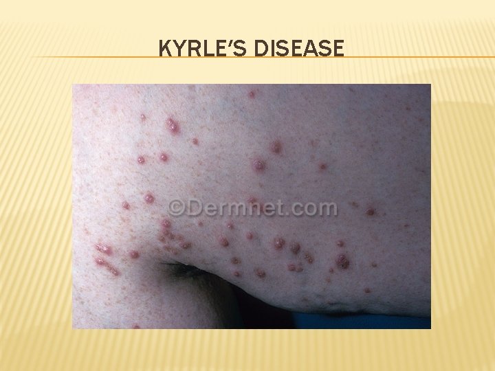 KYRLE′S DISEASE 