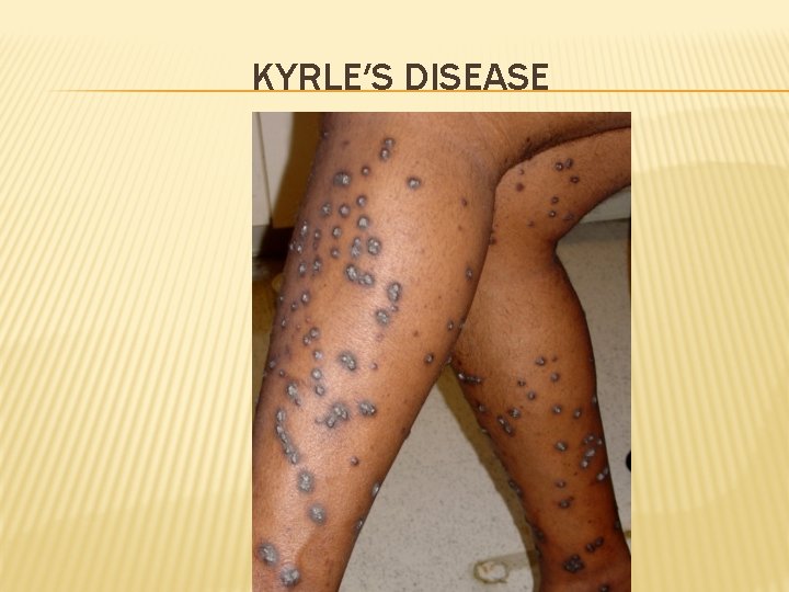 KYRLE′S DISEASE 
