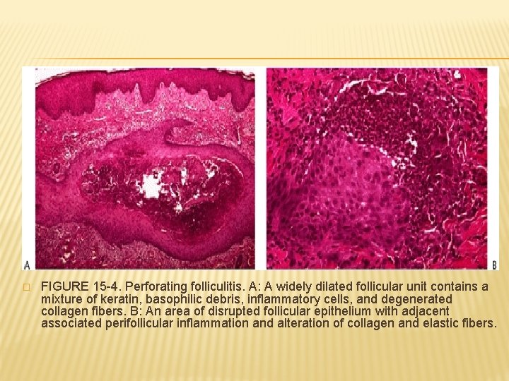 � FIGURE 15 -4. Perforating folliculitis. A: A widely dilated follicular unit contains a