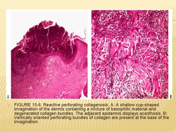 � FIGURE 15 -6. Reactive perforating collagenosis. A: A shallow cup-shaped invagination of the