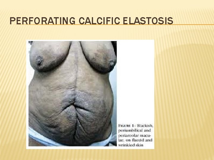 PERFORATING CALCIFIC ELASTOSIS 