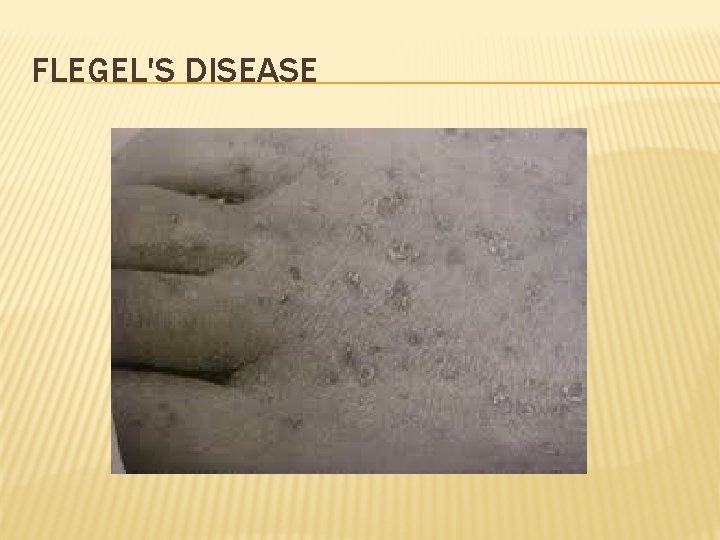 FLEGEL'S DISEASE 