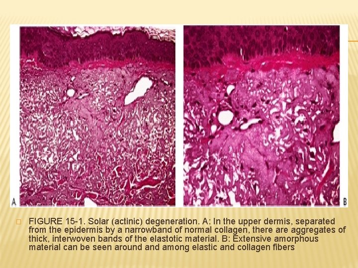 � FIGURE 15 -1. Solar (actinic) degeneration. A: In the upper dermis, separated from