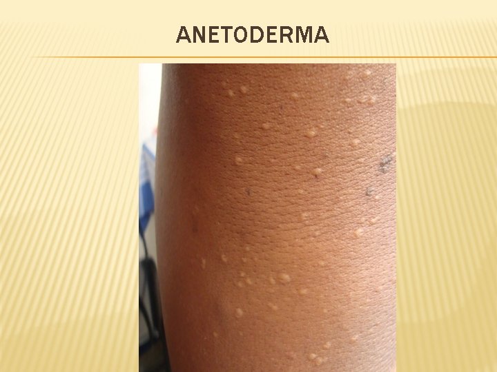 ANETODERMA 