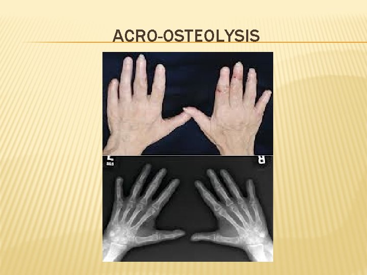 ACRO-OSTEOLYSIS 