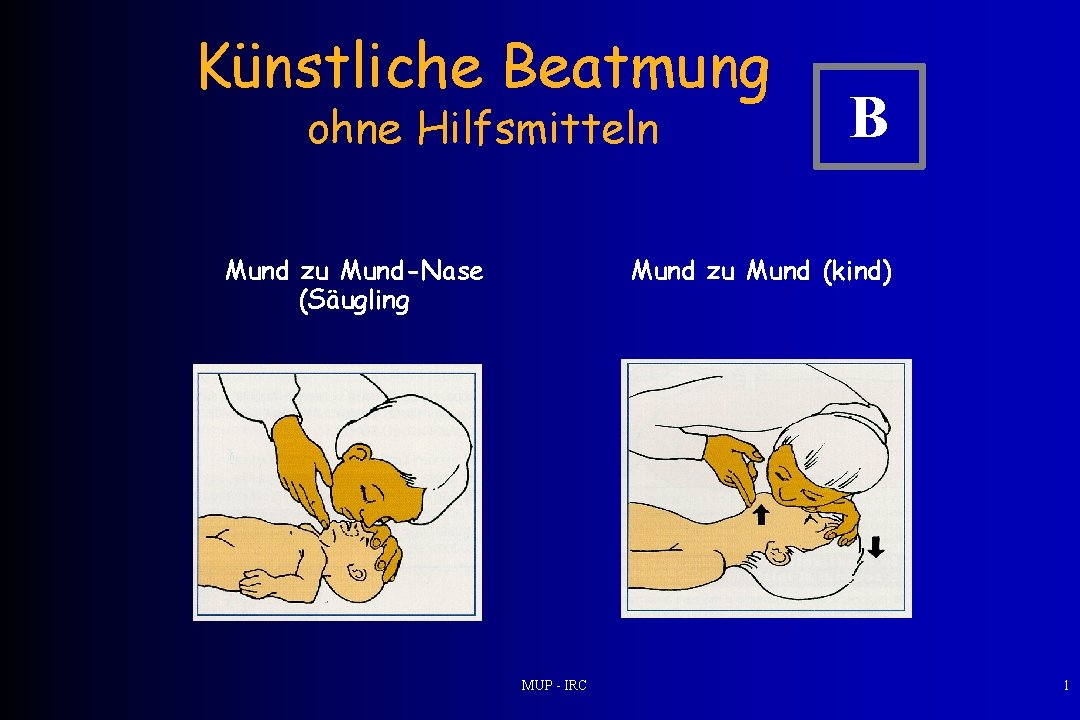 Künstliche Beatmung ohne Hilfsmitteln Mund zu Mund-Nase (Säugling B Mund zu Mund (kind) MUP