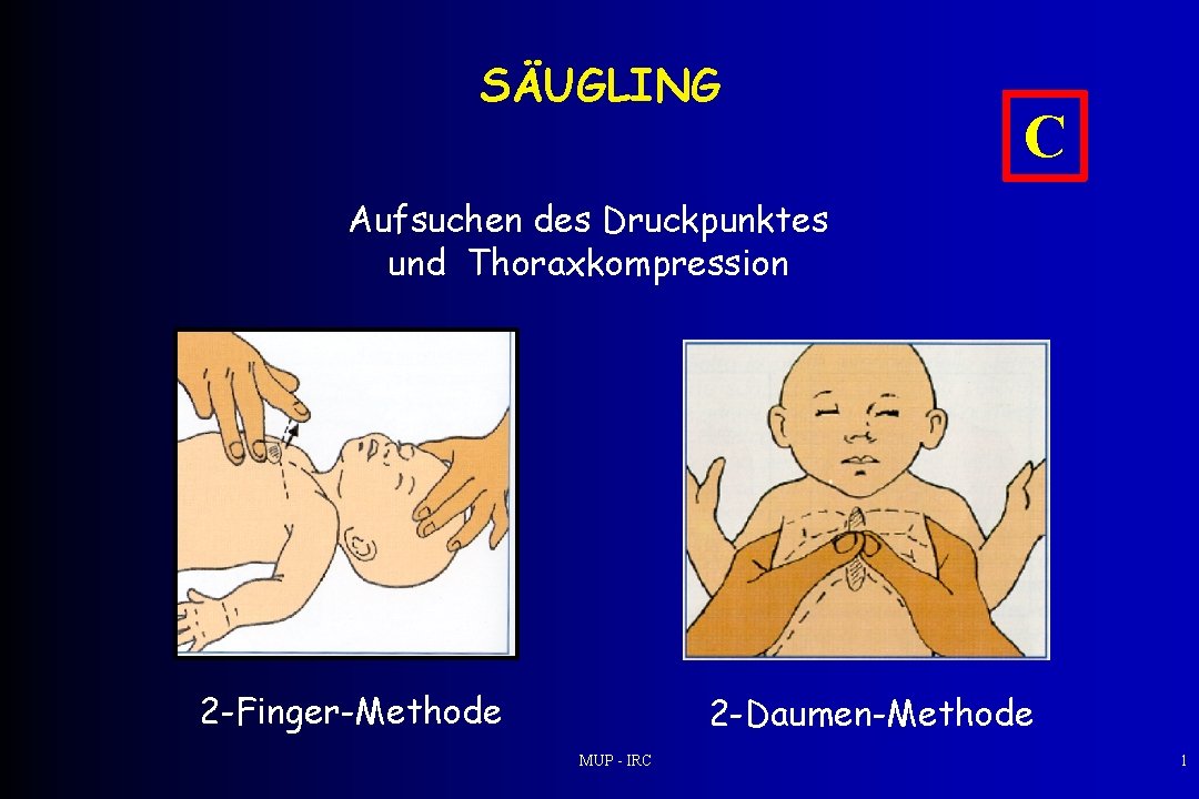 SÄUGLING C Aufsuchen des Druckpunktes und Thoraxkompression 2 -Finger-Methode 2 -Daumen-Methode MUP - IRC