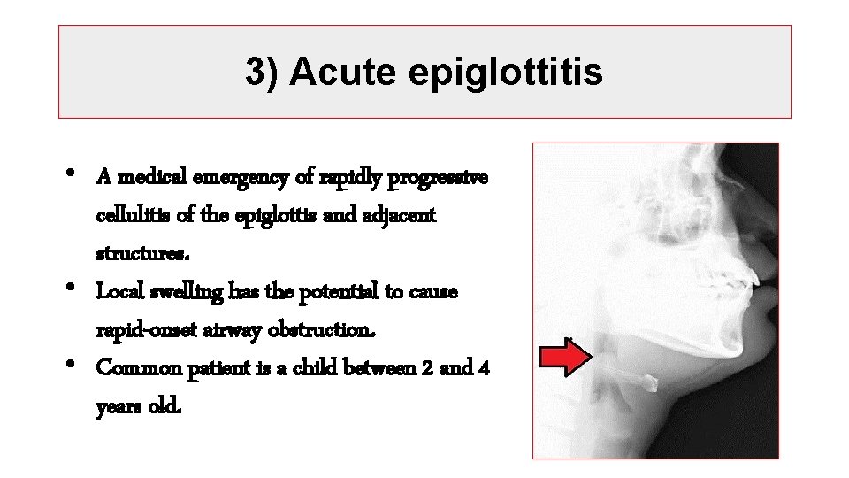 3) Acute epiglottitis • A medical emergency of rapidly progressive cellulitis of the epiglottis