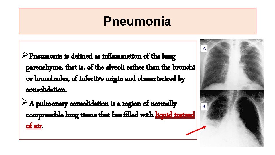 Pneumonia ØPneumonia is defined as inflammation of the lung parenchyma, that is, of the