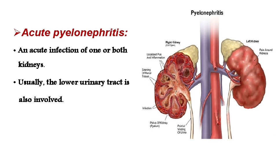 ØAcute pyelonephritis: • An acute infection of one or both kidneys. • Usually, the
