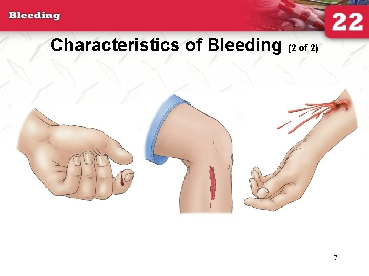Characteristics of Bleeding (2 of 2) 17 
