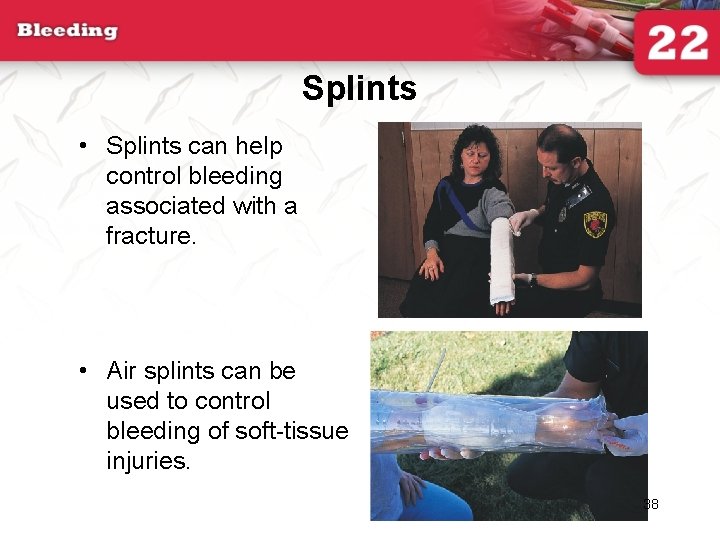 Splints • Splints can help control bleeding associated with a fracture. • Air splints