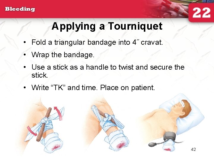 Applying a Tourniquet • Fold a triangular bandage into 4˝ cravat. • Wrap the