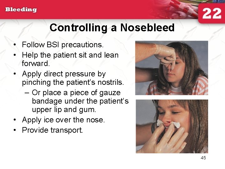 Controlling a Nosebleed • Follow BSI precautions. • Help the patient sit and lean