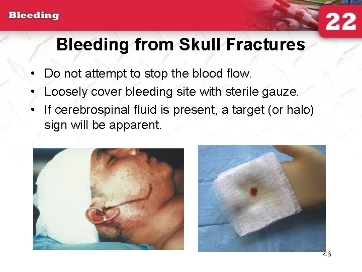 Bleeding from Skull Fractures • Do not attempt to stop the blood flow. •