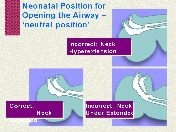 Neonatal Position for Opening the Airway – ‘neutral position’ Incorrect: Neck Hyperextension Correct: Neck
