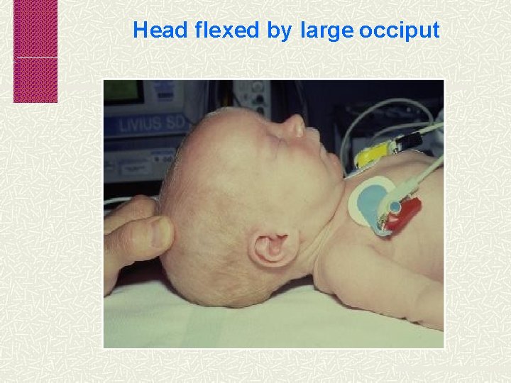 Head flexed by large occiput 
