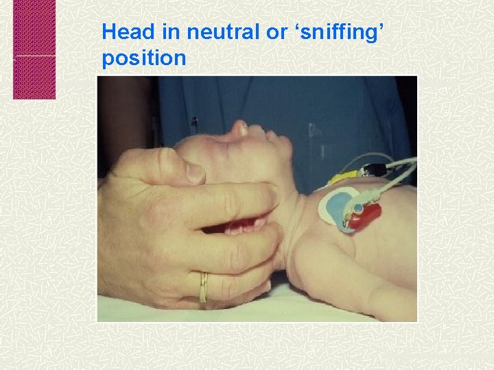 Head in neutral or ‘sniffing’ position 