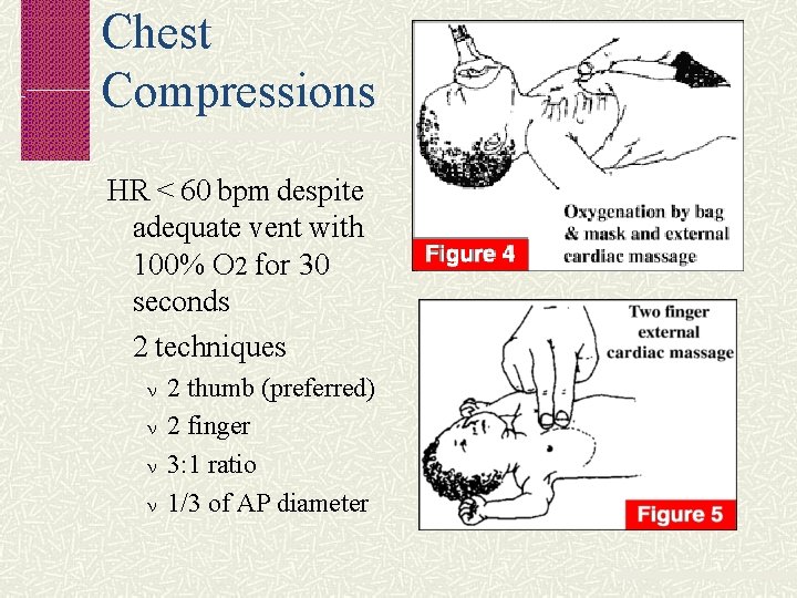 Chest Compressions HR < 60 bpm despite adequate vent with 100% O 2 for