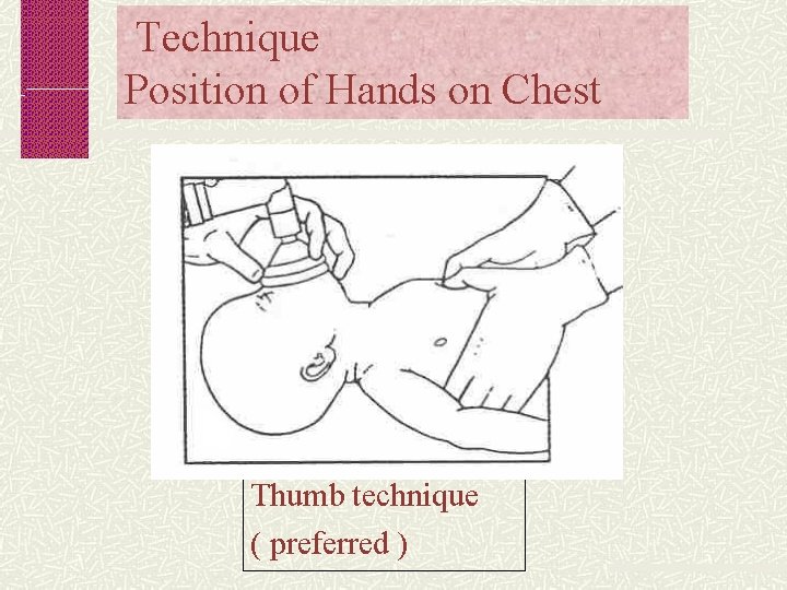 Technique Position of Hands on Chest Thumb technique ( preferred ) 