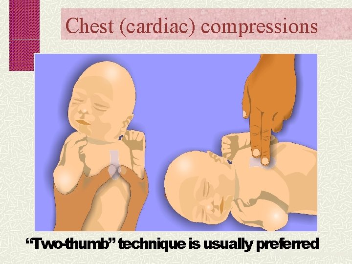 Chest (cardiac) compressions “Two-thumb” technique is usually preferred 