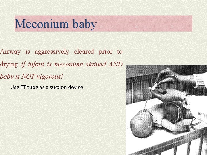 Meconium baby Airway is aggressively cleared prior to drying if infant is meconium stained