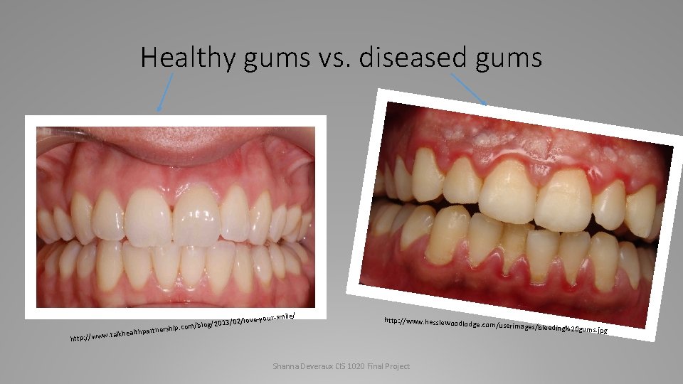 Healthy gums vs. diseased gums h nersh alkhealthpart ttp: //www. t ile/ /love-your-sm 2