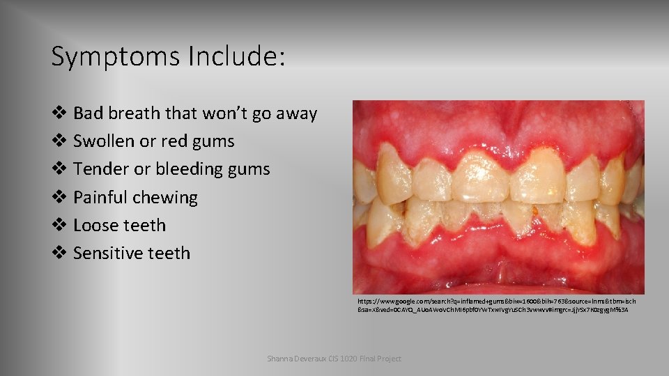 Symptoms Include: v Bad breath that won’t go away v Swollen or red gums