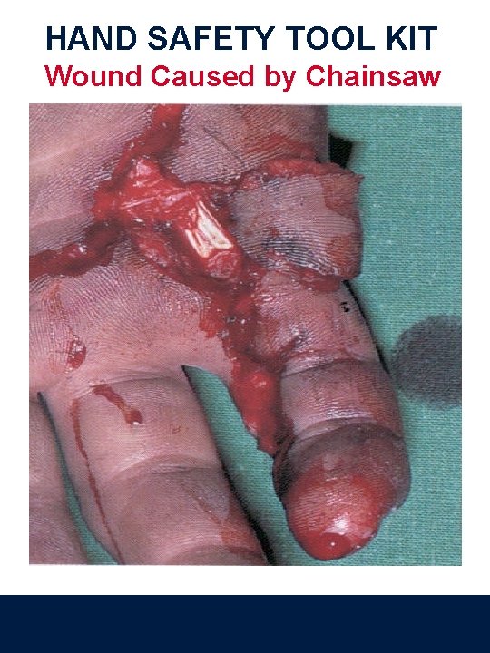 HAND SAFETY TOOL KIT Wound Caused by Chainsaw 