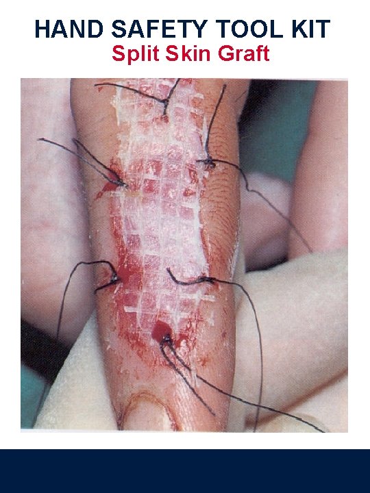 HAND SAFETY TOOL KIT Split Skin Graft 