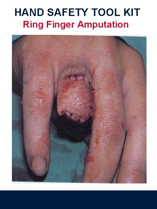 HAND SAFETY TOOL KIT Ring Finger Amputation 