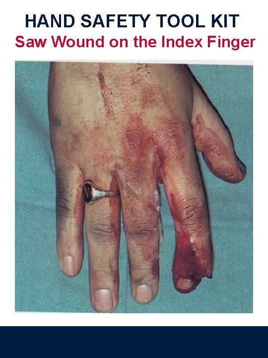 HAND SAFETY TOOL KIT Saw Wound on the Index Finger 