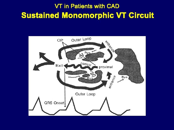 Sustained Monomorphic VT Circuit 