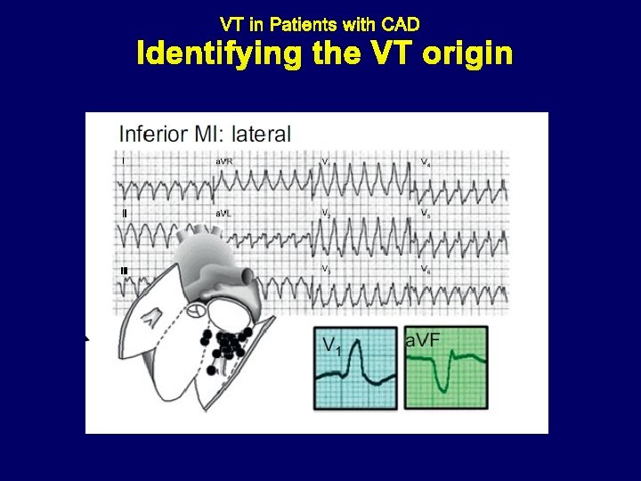 Identifying the VT origin 