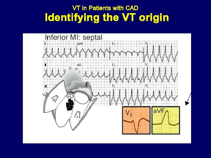 Identifying the VT origin 