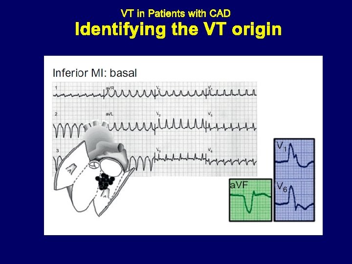 Identifying the VT origin 