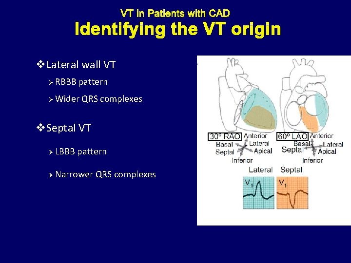 Identifying the VT origin v. Lateral wall VT Ø RBBB pattern Ø Wider QRS