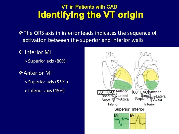 Identifying the VT origin v. The QRS axis in inferior leads indicates the sequence
