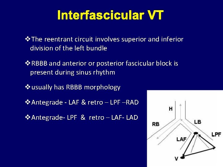 Interfascicular VT v. The reentrant circuit involves superior and inferior division of the left