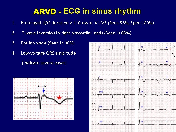 ARVD - ECG in sinus rhythm 1. Prolonged QRS duration ≥ 110 ms in