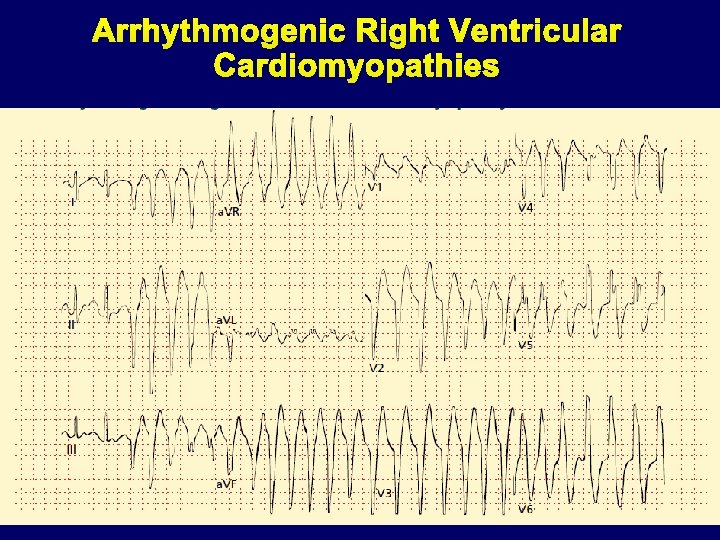 Arrhythmogenic Right Ventricular Cardiomyopathies 