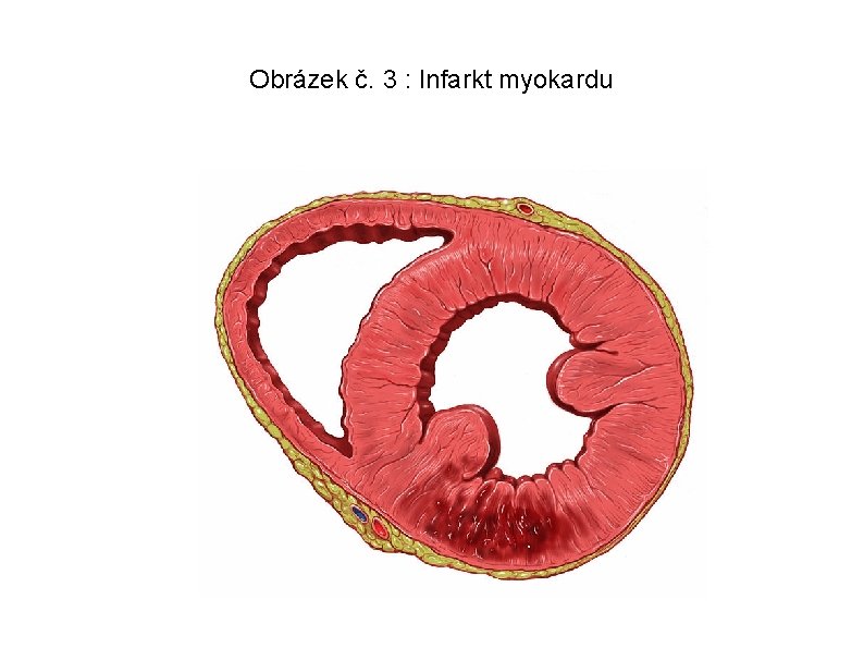 Obrázek č. 3 : Infarkt myokardu 