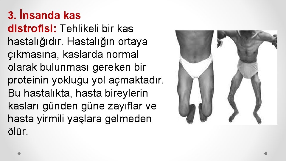 3. İnsanda kas distrofisi: Tehlikeli bir kas hastalığıdır. Hastalığın ortaya çıkmasına, kaslarda normal olarak