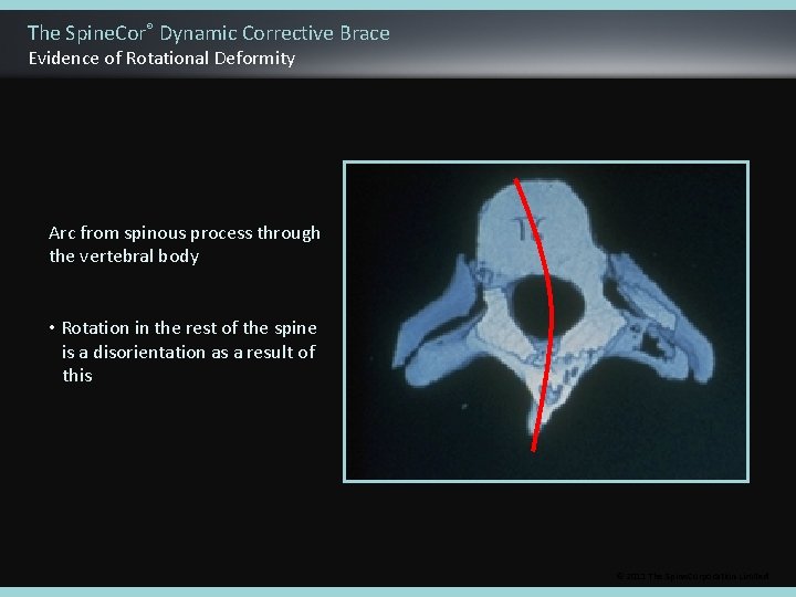 The Spine. Cor® Dynamic Corrective Brace Evidence of Rotational Deformity Arc from spinous process
