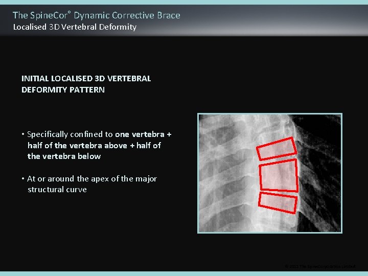 The Spine. Cor® Dynamic Corrective Brace Localised 3 D Vertebral Deformity INITIAL LOCALISED 3